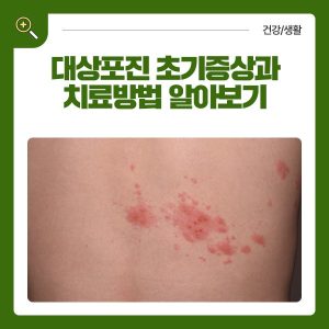 대상포진