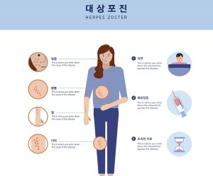 대상포진