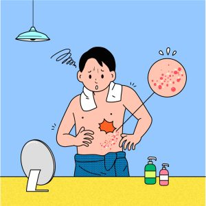 대상포진