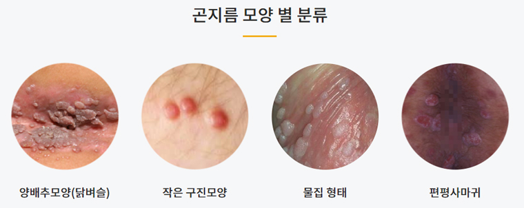 HPV 바이러스