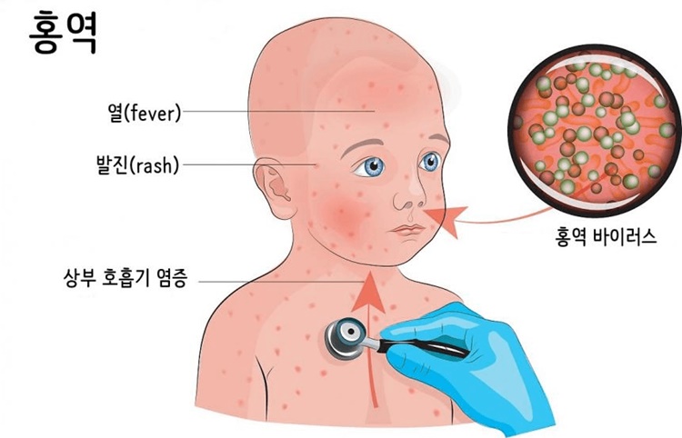 홍역 유행