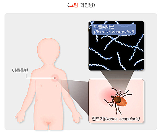 Lyme disease