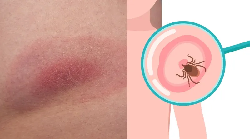 Lyme disease